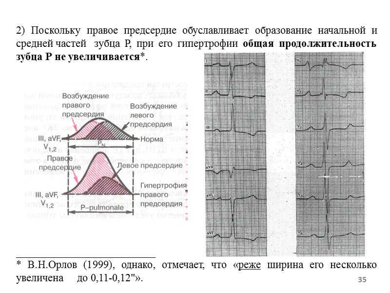 2) Поскольку правое предсердие обуславливает образование начальной и средней частей зубца Р, при его 2) Поскольку правое предсердие обуславливает образование начальной и средней частей зубца Р, при его